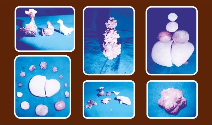BEST STONE SURGERY CENTER BY MINIMAL INVASIVE METHOD